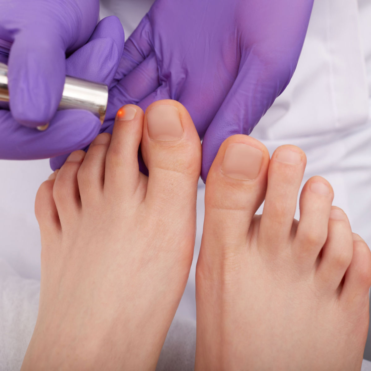 MyNewFeet's tweet photo. Laser special for Nail Fungus, only $297*.
Laser treatment consists of three consecutive sessions about one month apart.
#nail #fungus #laser #podiatrist 

*Appointment with a Doctor is required to make sure that you are a candidate and as such, other fees may apply. https://t.co/KICmLeYPm4