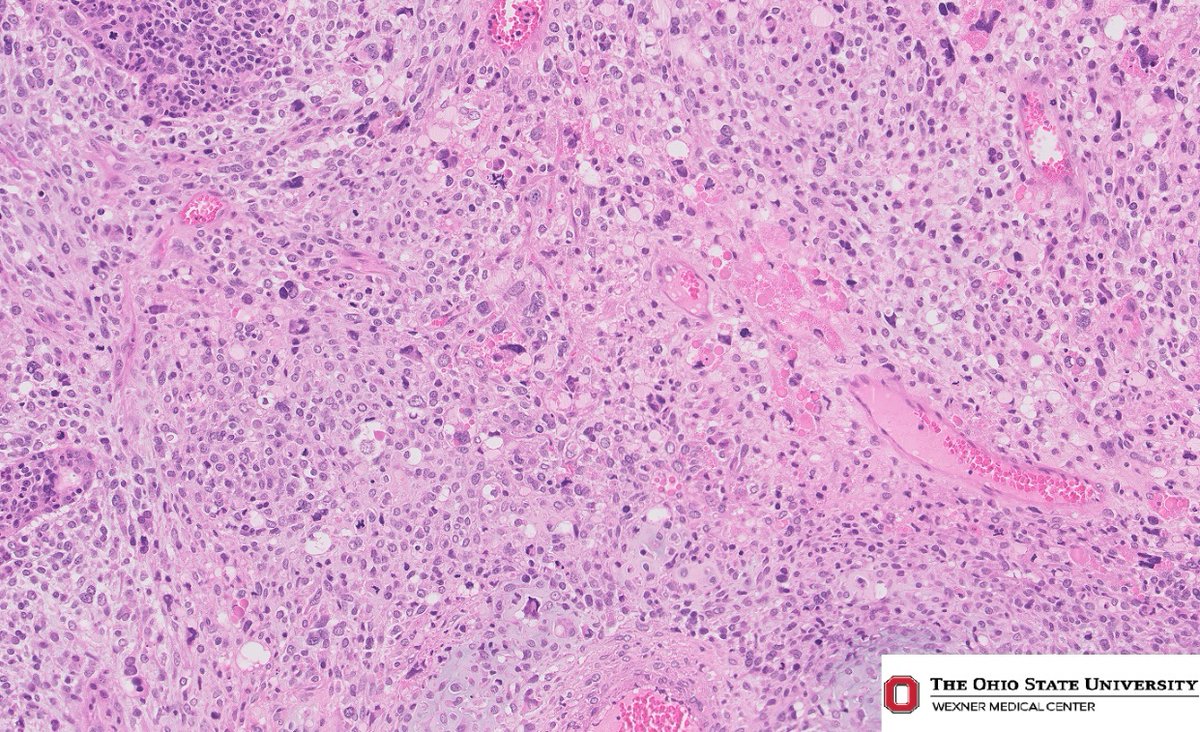 Uterine mass in a 58 year old female. What is the most likely diagnosis?
#PathTwitter #gynpath