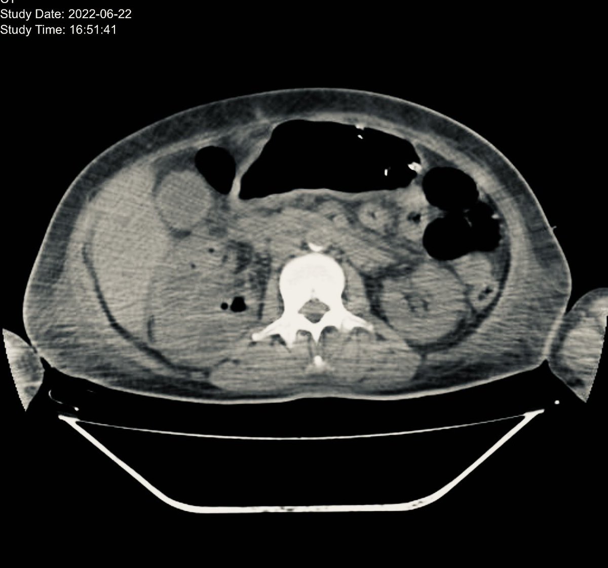 DannySilvaC1's tweet photo. 52 años DM IRC se observa Riñon derecho Pielonefritis enfisematosa 79 a 90% mortalidad. #nefrology #medicina interna #cirugia #urology ⁦⁦@GabrielaSFM93⁩ https://t.co/u72xfeFHJ7