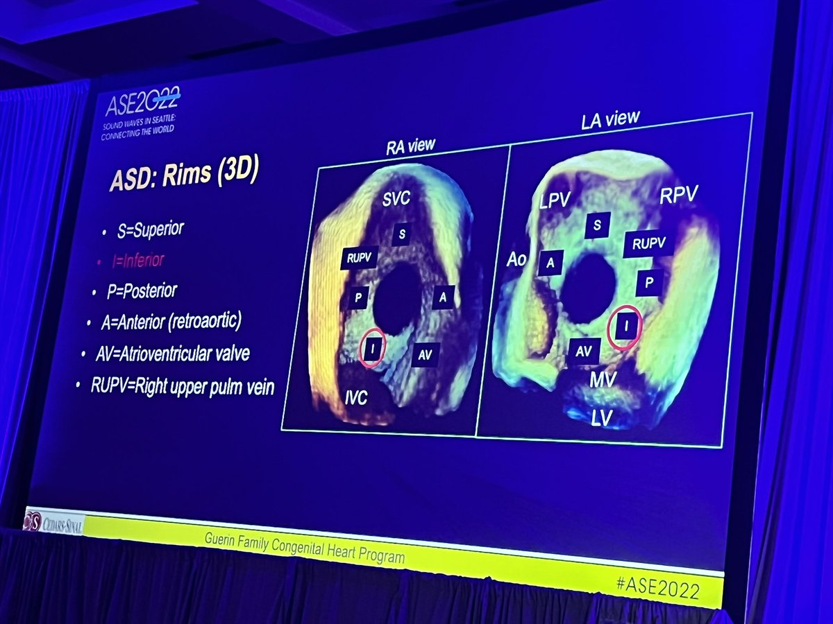 purviparwani's tweet photo. Define rims for the ASD device closure. 
Inferior rim > 5mm is really critical for device stability. Dr. Ruchi Garg: terrific talk on planning for interatrial septal devices #ASE2022 #iecho 
@ASE360 @hahn_rt 
@iamritu @EGarciaSayan @gb_mackensen @SLittleMD @NadeenFaza @AChoiHeart https://t.co/8JP5JqDJoR