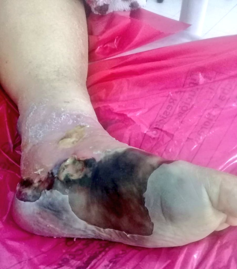 castellanosfj's tweet photo. Graciela tiene 70 años, intentó durante más de 6 meses tener acceso a un adecuado tratamiento para su enfermedad. Sin embargo, las demoras y negligencias administrativas persistieron. No fue atendida y ahora deben amputar su pie.
¡El modelo de salud tiene que cambiar! https://t.co/fg76KFrkJY