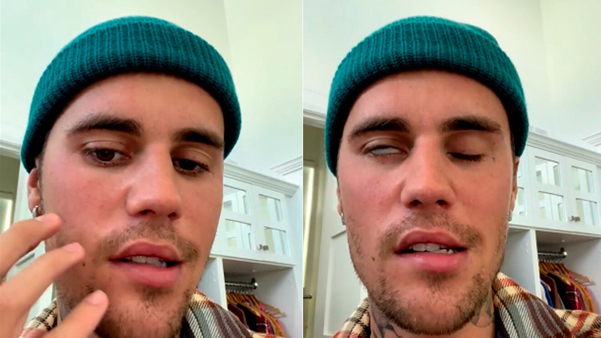 morontafelix's tweet photo. "Baby, baby, baby, ooh" 🎶
#JustinBieber cancela sus funciones porque sufre el síndrome Ramsay Hunt tipo 2.
¿El síndrome qué? Va mini #HiloBio 🧵 https://t.co/UvChabIORL