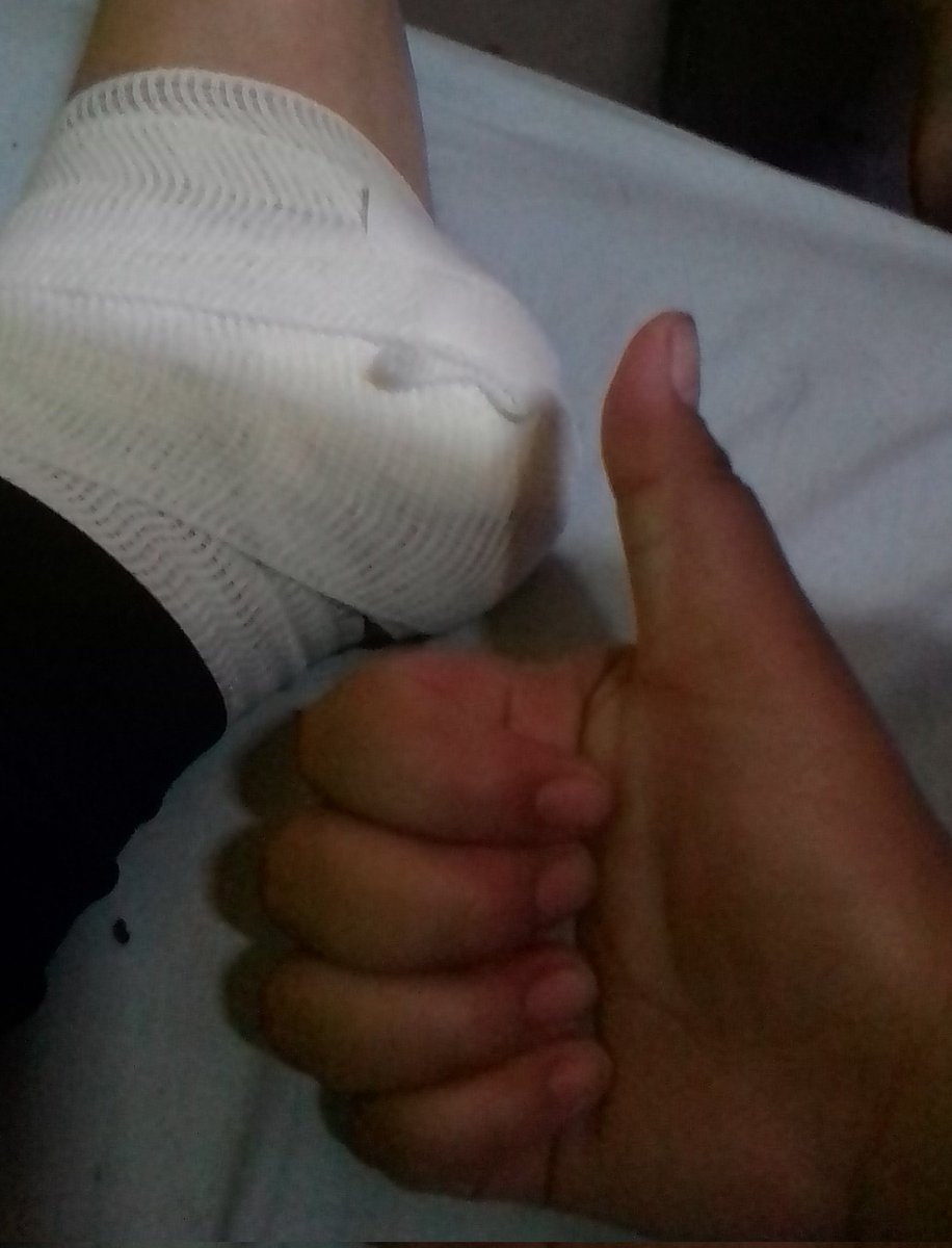 yeshdez's tweet photo. Me enterré un vidrio por pendeja y me tuvieron que abrir el pinche pie y me lo intentaron quitar sin anestesia y se sentía horrible que casi me voy con mamá coco  (no caminen descalzos) https://t.co/9ItOd2Tw4n