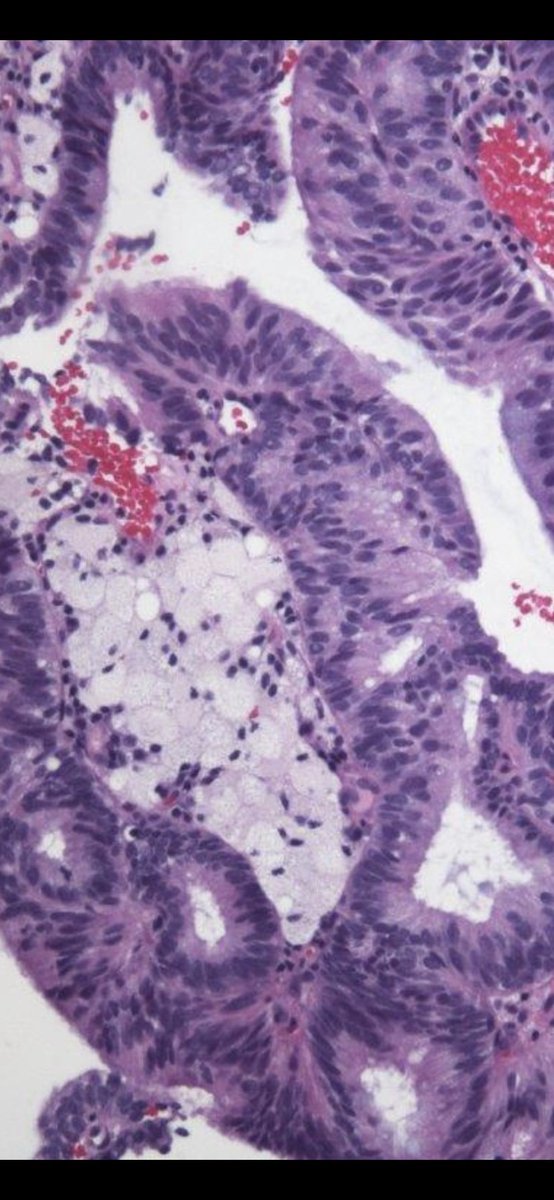 Presence of histiocytes in Pap- test of post-menopausal women should not be ignored. Example of histiocytes
associated with endometrial adenocarcinoma, 
pubmed.ncbi.nlm.nih.gov/6184472/https:…
