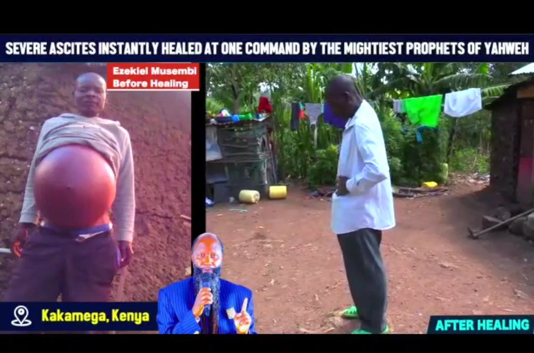 FridahEndala's tweet photo. Severe ASCITES healed at one command by the Mega PROPHETS of the LORD yet again. #AtOneSingleDecree https://t.co/jF7LLsjB23