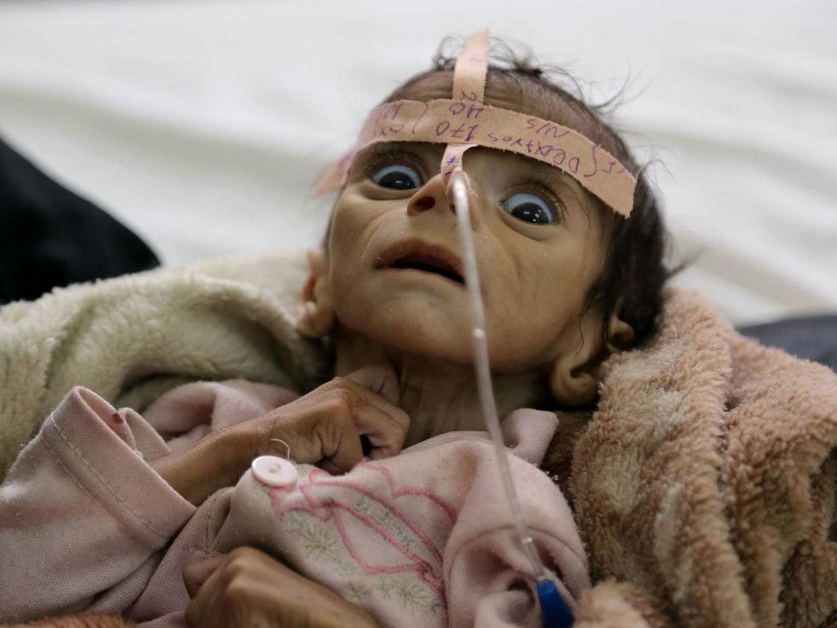 BdGEORGES's tweet photo. Au #Yémen, la guerre a provoqué l’une des pires tragédies au monde, avec des centaines de milliers de morts, et des enfants aux prises avec une faim aiguë et la famine. On peut fermer les yeux, ou choisir de regarder pour prendre la mesure de la tragédie ! https://t.co/EPKcnF1erR