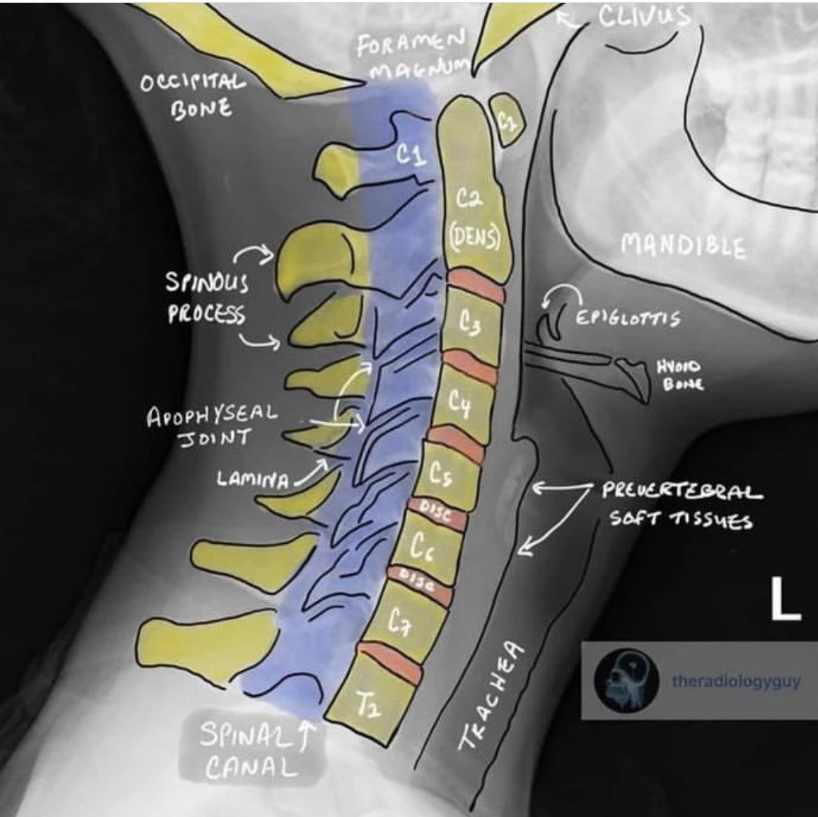 OGdukeneurosurg's tweet image. A great teaching slide to perfect your knowledge of neck anatomy.