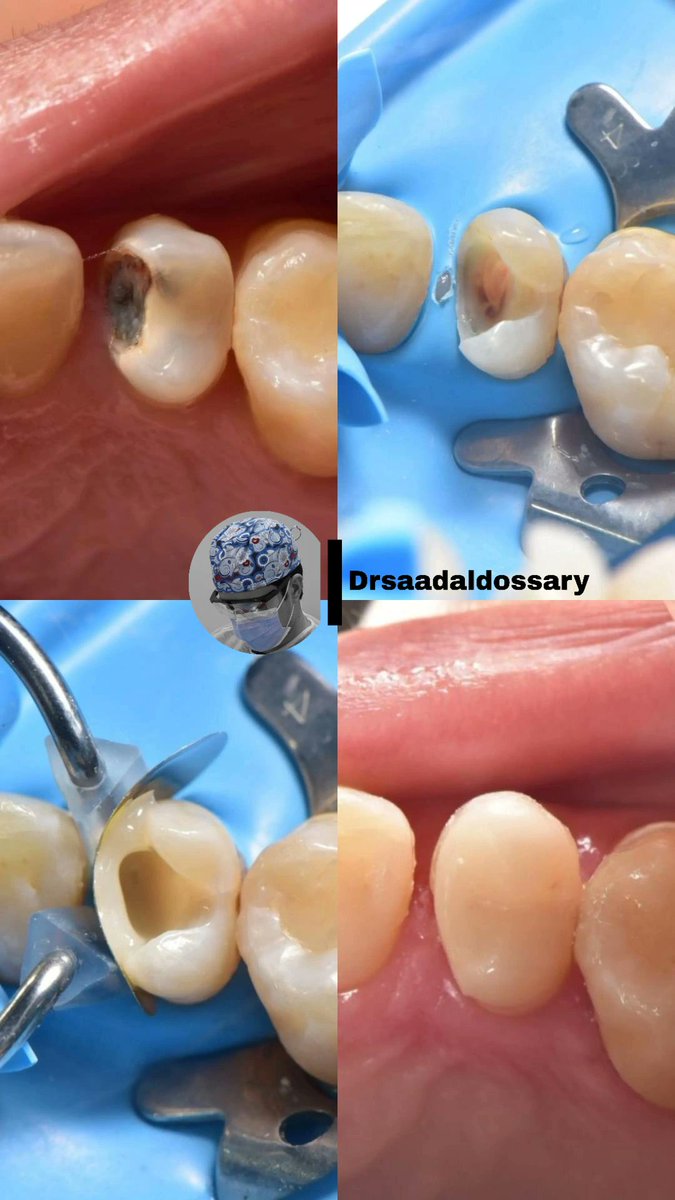 Drsaadaldossary's tweet image. حشوة تجميلية 
#directcomposite