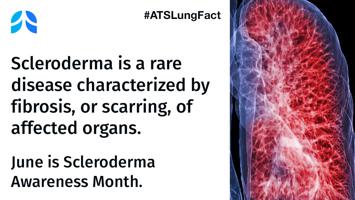 atscommunity's tweet image. When #scleroderma affects the lungs, it may cause symptoms such as fatigue, shortness of breath, or cough, and is usually associated with interstitial lung disease (pulmonary fibrosis) and/or pulmonary hypertension. #ATSLungFact #KnowScleroderma @scleroderma