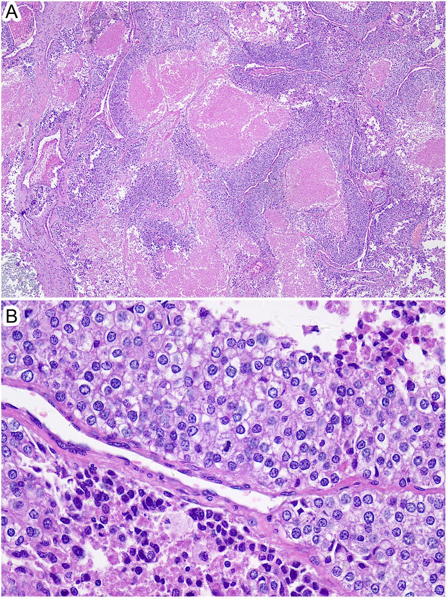 Poorly differentiated thyroid carcinoma: a clinician's perspective. An #ENDO2022 featured article by Zhiyan Liu et al., Shanghai Sixth People's Hospital, China. ow.ly/MTC530slQtJ