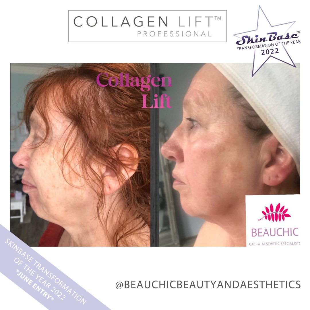 SkinBase_facial's tweet image. ⭐️ June transformation with this fabulous entry from Beau Chic Beauty &amp;amp; Aesthetics.

These fantastic results were achieved through a 6 treatment course of Collagen Lift. 

Click the link in our bio for your chance to Win a Holiday! #skinbase #collagenlift #transformation22