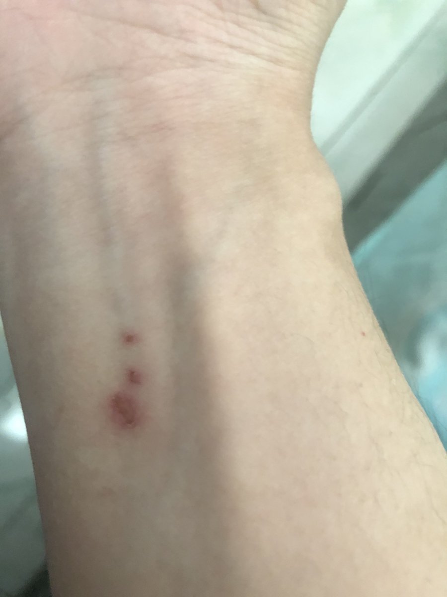 被狗咬到