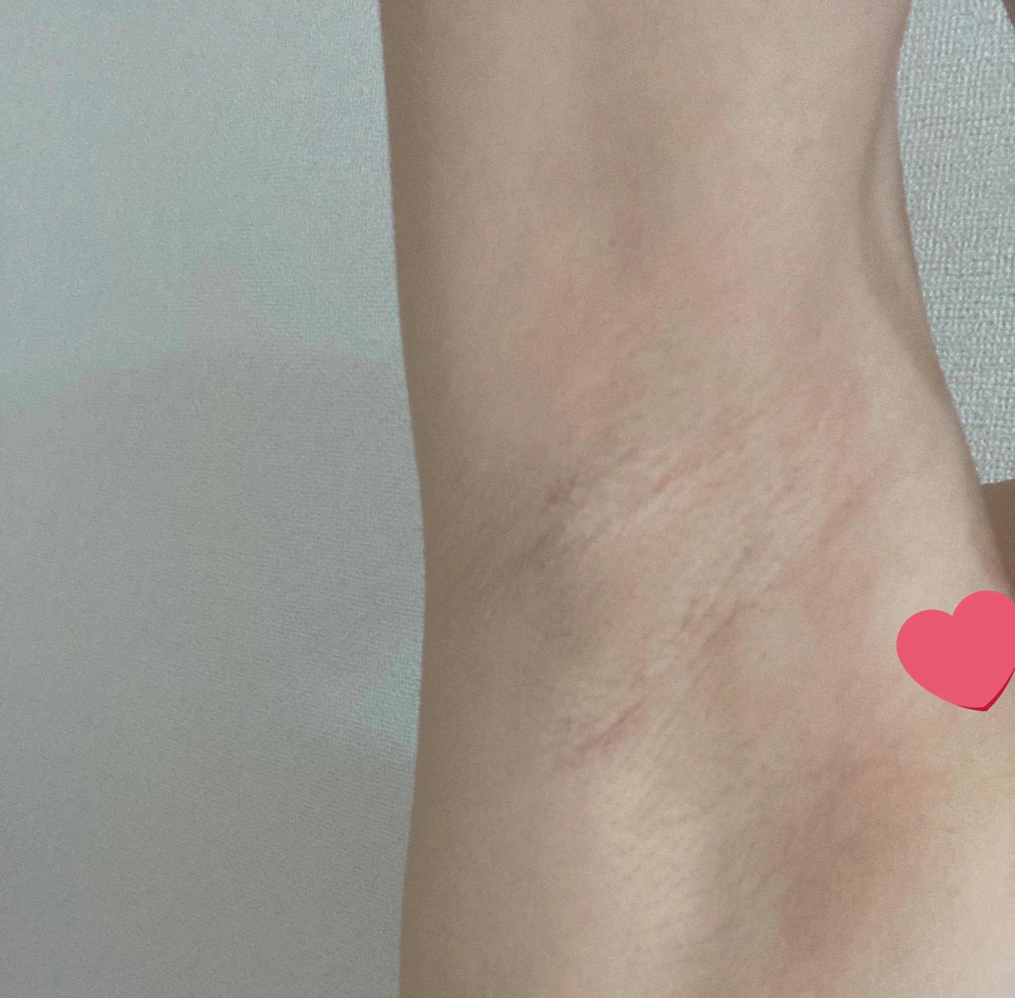 めたもんもん もうすぐ1年 脇の下シワが切開した所 元々シワシワだからか上のシワと馴染んでてわからない笑 先生が上手いのか私がシワシワなのか T Co Dcx7u6528p Twitter