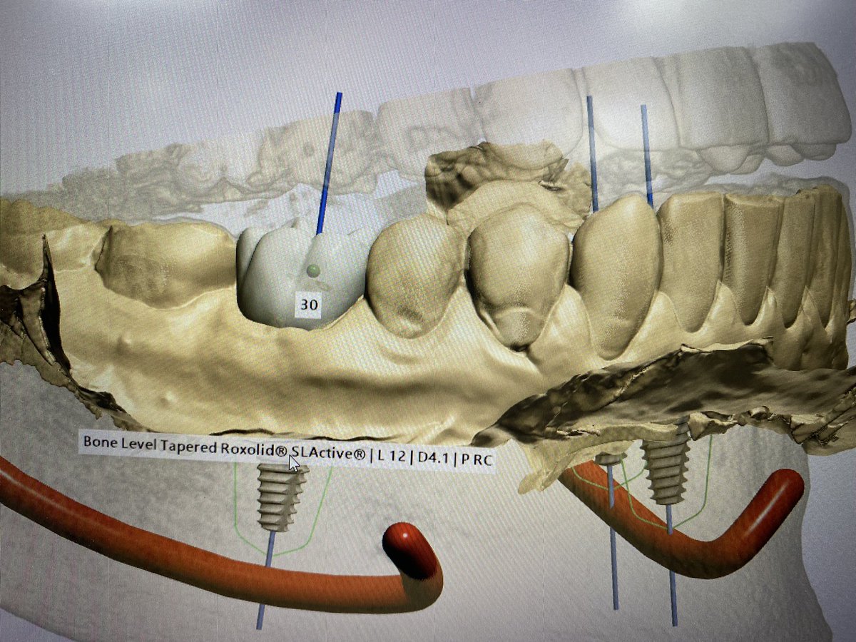 LauraDra's tweet photo. Colocación de Implantes Planificados Digitalmente #implants #implantology #oralsurgery https://t.co/Wzo2Lp7wLE