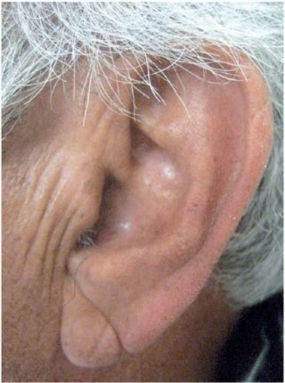 Frank’s sign: having this diagonal crease on the earlobe is associated with a 45% increased risk of cardiovascular disease. 

#MedTwitter
