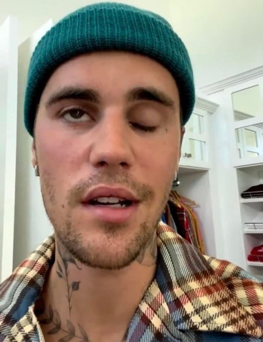 RayArmat's tweet photo. Not sure what type of vax. #JustinBieber received but the Herpes Zoster (Ramsay Hunt Syndrome), is the same neurological pathology which was reported by #Pfizer's own post-marketing report as the 2nd most common adverse event (after pyrexia, a euphemism for fever/infection) https://t.co/C5PUeknCCh
