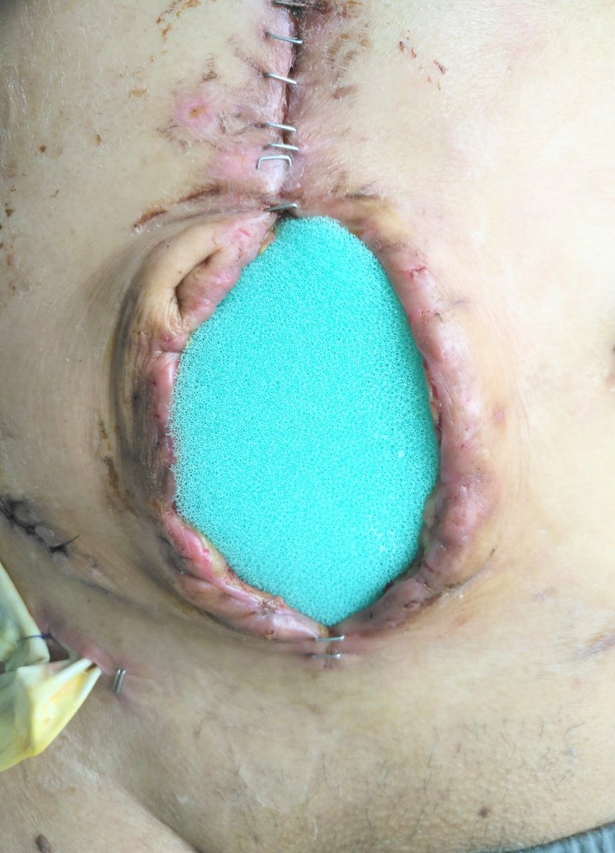 UcolorectaLPBol's tweet photo. Management of enteroatmospheric fistula with vacuum pump:
68-year-old patient, operated for obstructive sigmoid adenocarcinoma, sigmoid resection and terminal colostomy were performed #SoMe4Surgery #coloncancer #fistula @MISIRG1 @SAGES_Updares @debby_keller @almagoch @migueriv69 https://t.co/HHMZdmdQW8
