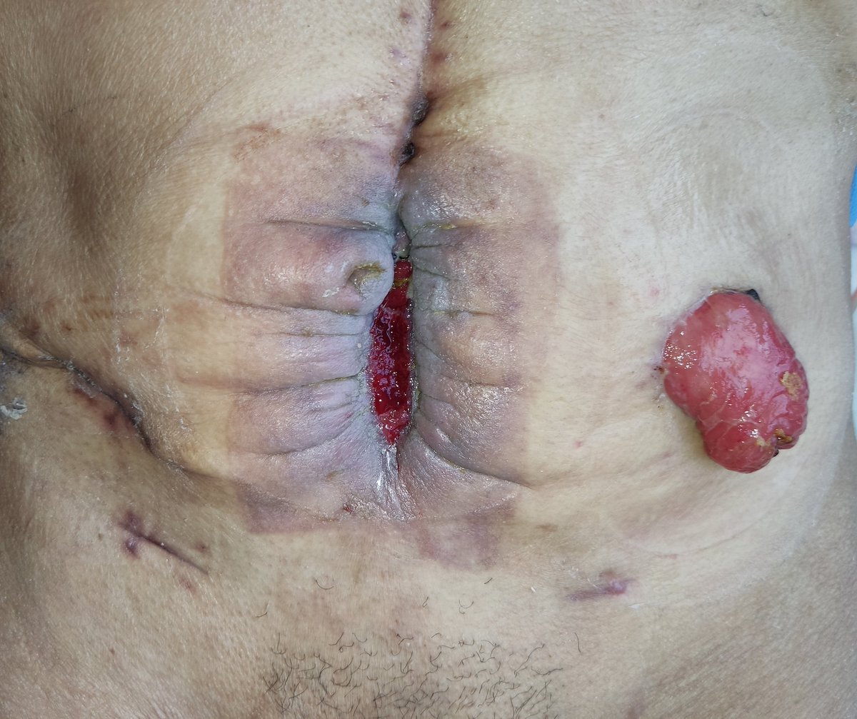 UcolorectaLPBol's tweet photo. 125 and 40 mm Hg. The patient was fed normally. Fistula was close at 3 weeks. In patients nutritionally compromised by cancer and fasting, non-surgical management of postoperative enteroatmospheric fistulae should be attempted. The vacuum pump is a good option. https://t.co/sWHGbNGze8
