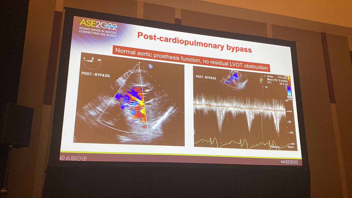 Another jam-packed session as part of the #periopecho track at the #ASE2022 <a href="/ASE360/">American Society of Echocardiography</a> with <a href="/JeremyThaden/">Jeremy Thaden</a> <a href="/SheelaPaiCole/">Sheela Pai Cole</a> <a href="/smccartney31/">Summer Mccartney ✂</a> is ongoing in Room 6A right now.