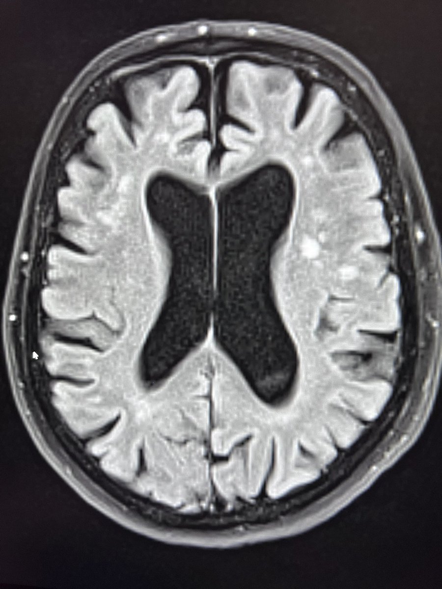 drmankad's tweet photo. When should a radiologist start suspecting #normalpressure hydrocephalus? Operating outside my usual #pedineurorad comfort zone, but we do like the challenge! This is a 65 year old lady with incontinence. I can see the #glymphatics are not happily flowing here. https://t.co/aZVFbAkldF