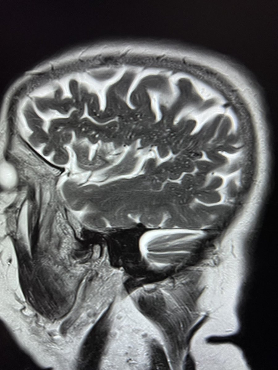 When should a radiologist start suspecting #normalpressure hydrocephalus? Operating outside my usual #pedineurorad comfort zone, but we do like the challenge! This is a 65 year old lady with incontinence. I can see the #glymphatics are not happily flowing here.
