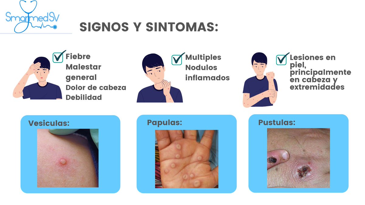 SmartMed_sv's tweet photo. 👉Hablemos un poco sobre :
🔹La viruela del mono 🔹

Escrito por : Dra. Ana Lorena Aquino
#SmartMed_sv #Smarttalksv 
@AnaLoreAquino https://t.co/awVgNATBDL