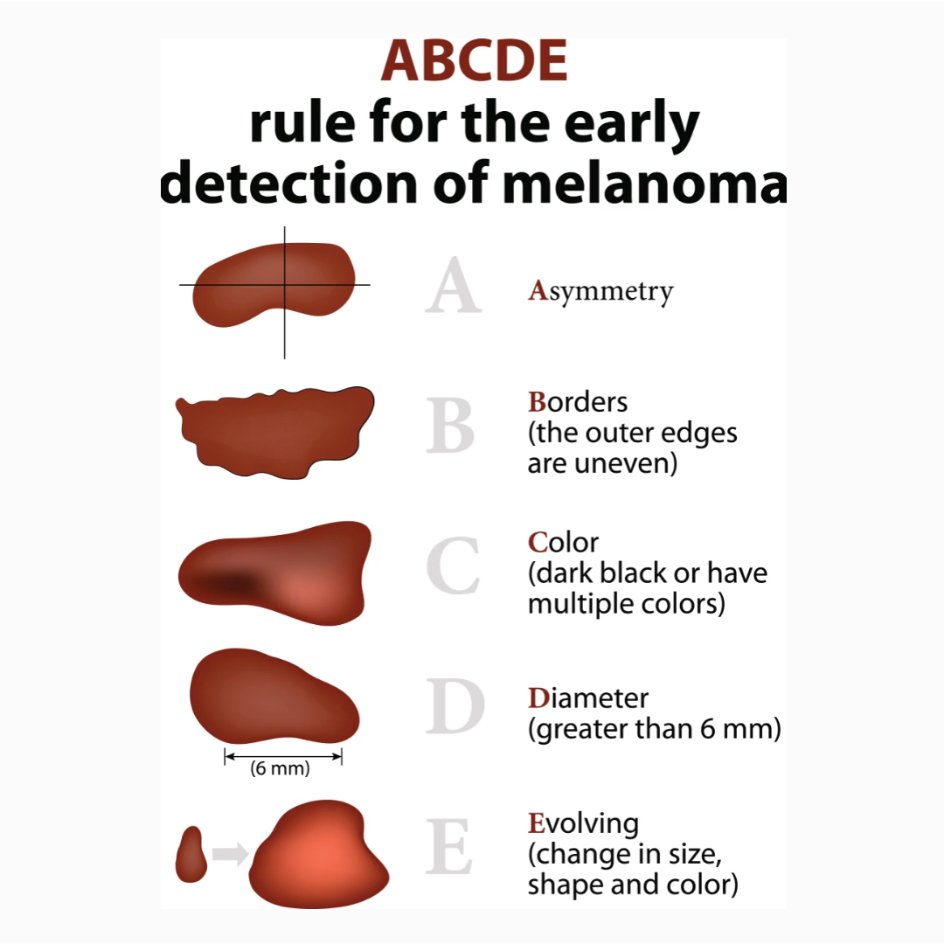 drhellers's tweet image. The ABCDE rule for melanoma tells you what to look for when examining your skin.
The A stands for asymmetrical. One half of a cancerous spot or mole may not match the other if you were to split the mole in half. Noncancerous moles are typically symmetrical.
B is for border....
