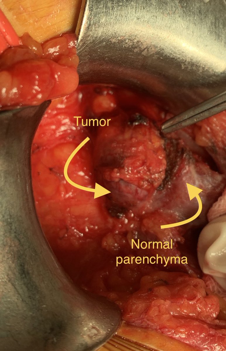 AcademicOner's tweet photo. Radiosurgeon should be told to a radiologist who enters the operation and does RF ablation to a tumor in a transplanted kidney. Thanks to our transplantation @tayfunoktar @OrhanZiylan @tzevattefik and uroradiology team #barisbakir for good colloberation with us @itfuroloncology https://t.co/2YRtOMw34e