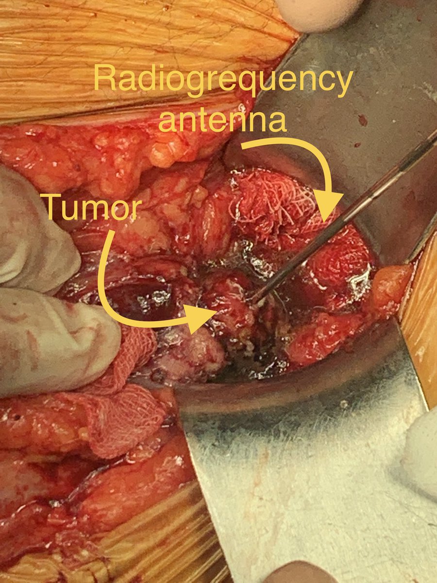 Oner Sanli Academic (@academiconer) on Twitter photo Radiosurgeon should be told to a radiologist who enters the operation and does RF ablation to a tumor in a transplanted kidney. Thanks to our transplantation <a href="/tayfunoktar/">Tayfun Oktar</a> <a href="/OrhanZiylan/">Orhan Ziylan</a> <a href="/tzevattefik/">Tzevat TEFIK</a> and uroradiology team #barisbakir for good colloberation with us <a href="/itfuroloncology/">İTF Üroloji A.D. Ürolojik Onkoloji Bilim Dalı</a> Radiosurgeon should be told to a radiologist who enters the operation and does RF ablation to a tumor in a transplanted kidney. Thanks to our transplantation <a href="/tayfunoktar/">Tayfun Oktar</a> <a href="/OrhanZiylan/">Orhan Ziylan</a> <a href="/tzevattefik/">Tzevat TEFIK</a> and uroradiology team #barisbakir for good colloberation with us <a href="/itfuroloncology/">İTF Üroloji A.D. Ürolojik Onkoloji Bilim Dalı</a>