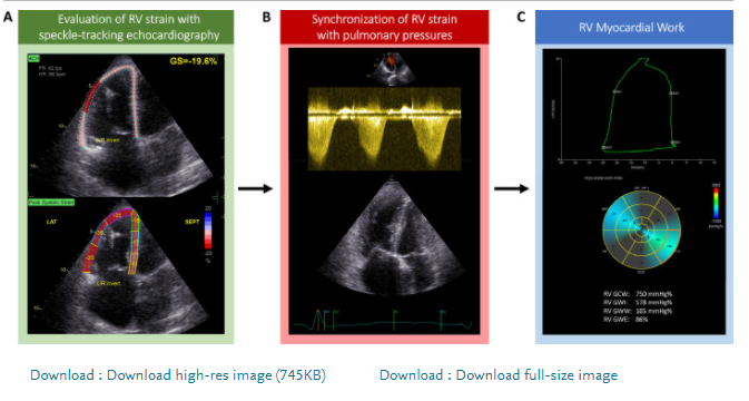 VDelgadoGarcia's tweet photo. Right Ventricular Myocardial Work Characterization in Patients With Pulmonary Hypertension 👉https://t.co/PiD1do5hFd @SteeleButcherMD @VKamperidis https://t.co/dHTroVZakS