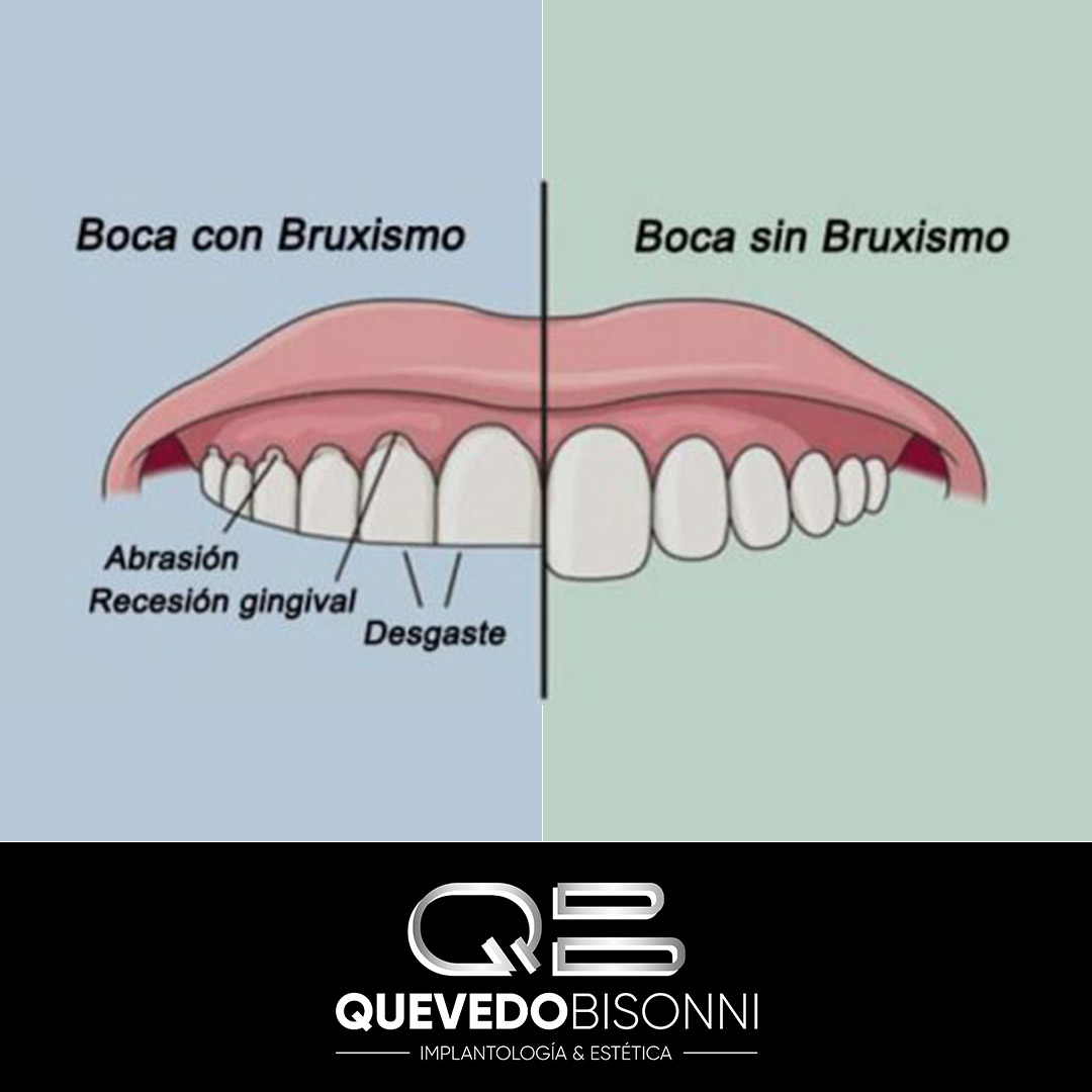 CQuevedoBisonni's tweet photo. ¡Buenos días Sonrisas! ¿Cuáles son los síntomas de Bruxismo?
Los pacientes con bruxismo presentan un fuerte desgaste de los dientes unido a un dolor de mandibular intenso, que a menudo deriva en fuertes dolores de cabeza.
.
.
#dientessanos #bocasana https://t.co/bkOGoV53cg