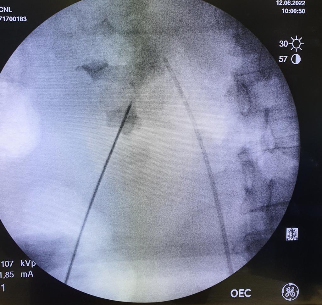 DRAAA86's tweet photo. Very proud of PGY3 @kuwaituroboard 
@abdullahnzy &amp; Salah Alkadir
Performing Mini-Perc 
🔴Triangulation technique 
🔴Stone free 
🔴Greet pre.op, intraop &amp;post op. caring of patients 
@hazemelmansy1 tech. easy &amp; reproducible 
Keep it up 👍 @kuwaituroboard 
#Endourology
#PCNL https://t.co/4XOSyCzbG8