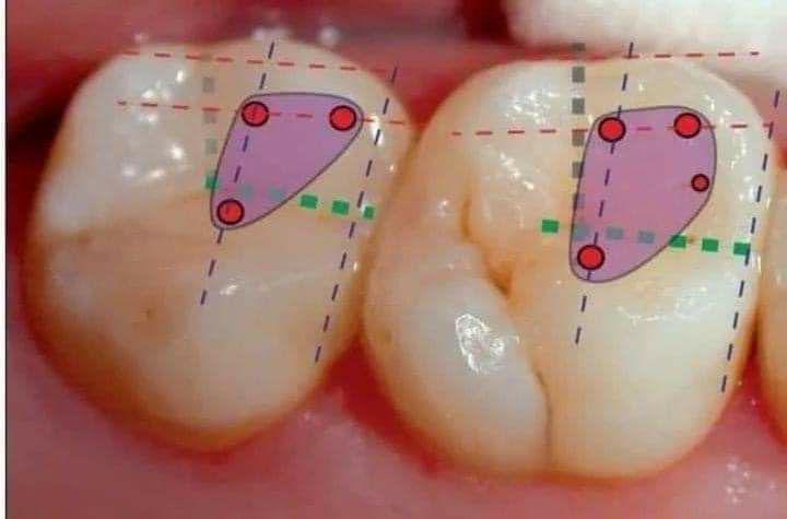 Shape of access cavity with location of orifices..