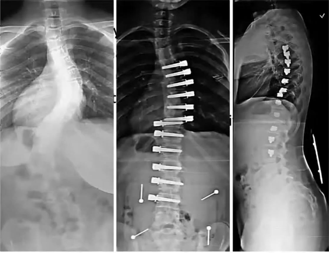 drhiteshg's tweet photo. This is a procedure done on a 11 year old kid with spine deformity. What "principle" has been employed here?
A. Fusion
B. Hueter Volkmann Law
C. Wolf's Law
D. Growth Arrest
#orthotwitter #orthopaedicprinciples #oite #abos #fracs #frcsc #frcsorth #msorth #dnborth #USMLE https://t.co/YFNYUafcvO