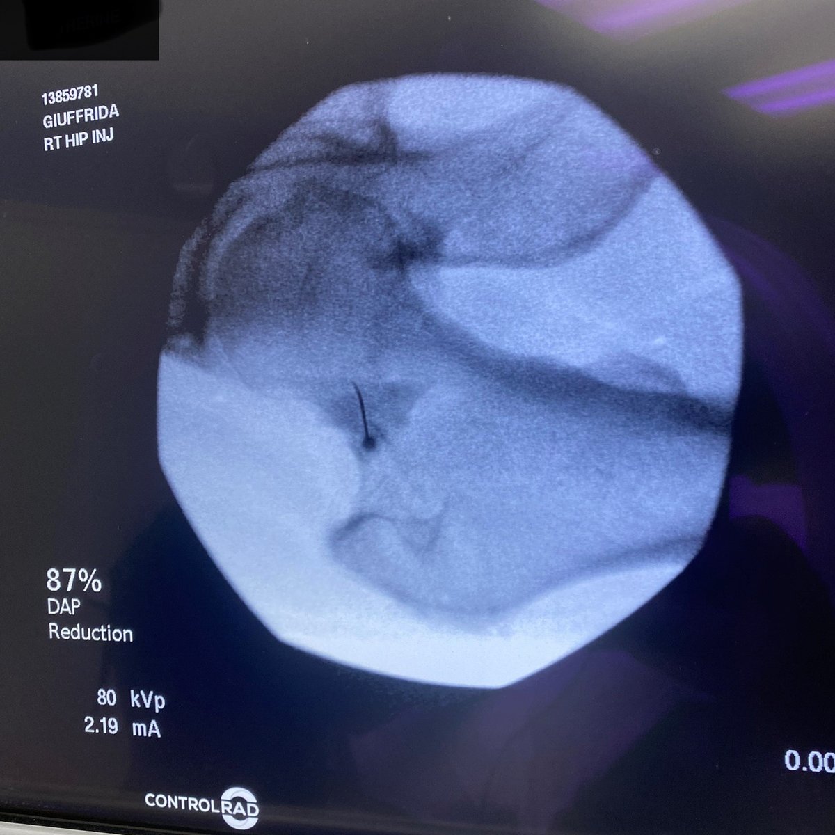 Shout out to Cantor Spine Center, Dr. Giuffrida and his staff for being supporters of ControlRad’s mission to make operating rooms safer for medical staff and patients by reducing their exposure to radiation. Our technology reduced their exposure by 87% in this hip injection.