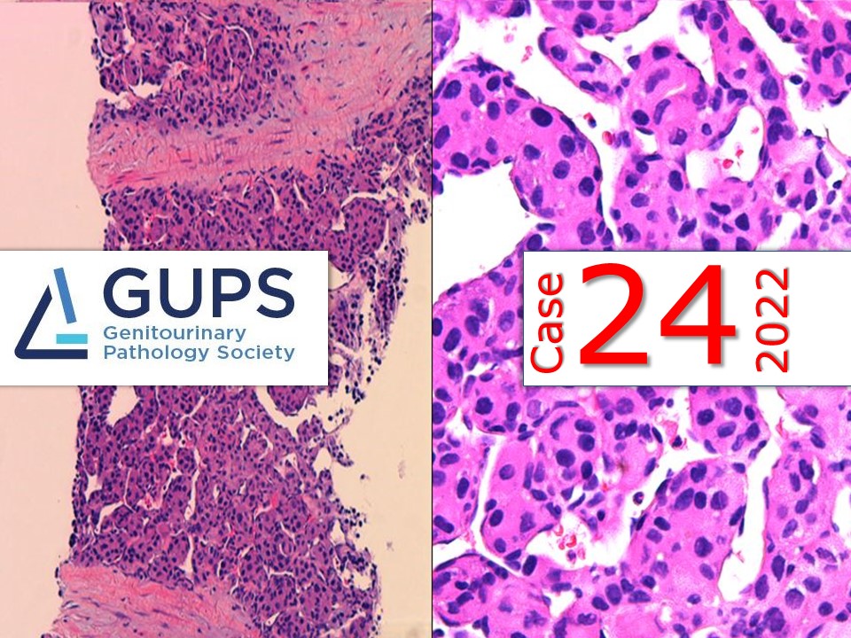A male in his 30s with hematuria, dysuria, and constipation with large prostate mass.

Contributors: @Paenox, C. Morrison, K. Cooper, <a href="/lalpritu/">Priti Lal</a>, <a href="/RebaD_22/">Reba Daniel</a>

The <a href="/GU_Path_Society/">GU Pathology Society (GUPS)</a> Case of the Week: gupathsociety.org/COW-2022-24

Send your cases to @akgulMD 
#GUPSCOW #GUpath #pathology