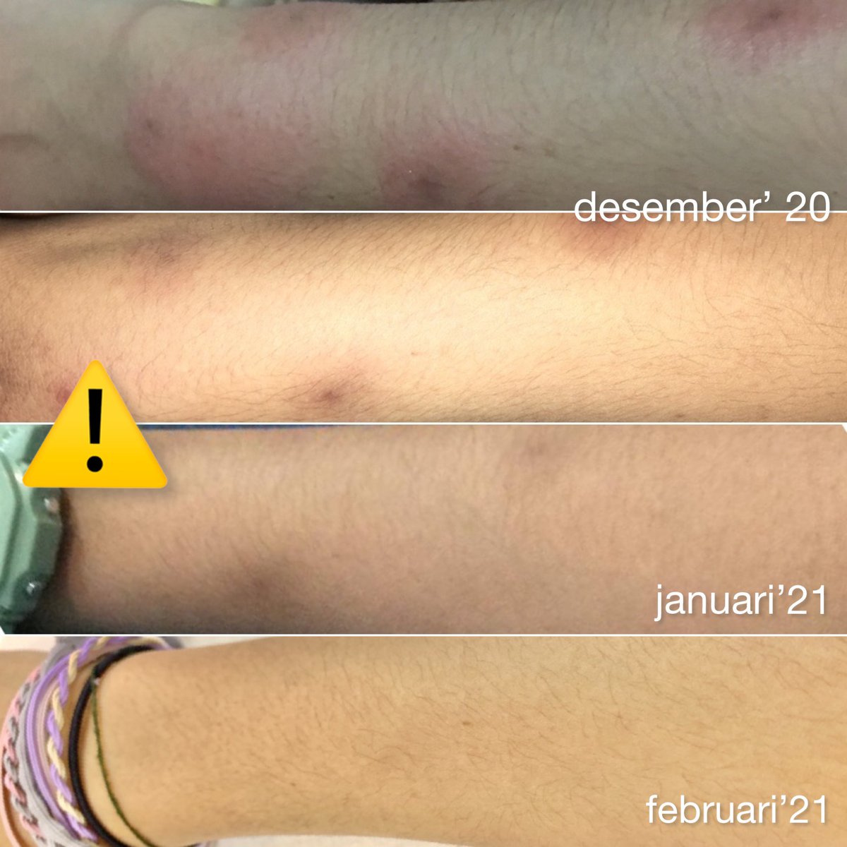 ⚠️ Aku mau kasih tips 

Bagaimana cara aku menghilangkan bekas hitam dikulit dalam waktu 2 bulan aja!

Simak baik-baik perjalan kulit sampai akhirnya sembuh dari bekas-bekas hitam ini👏🏻

—a thread
#racunbodycare #racunskincare