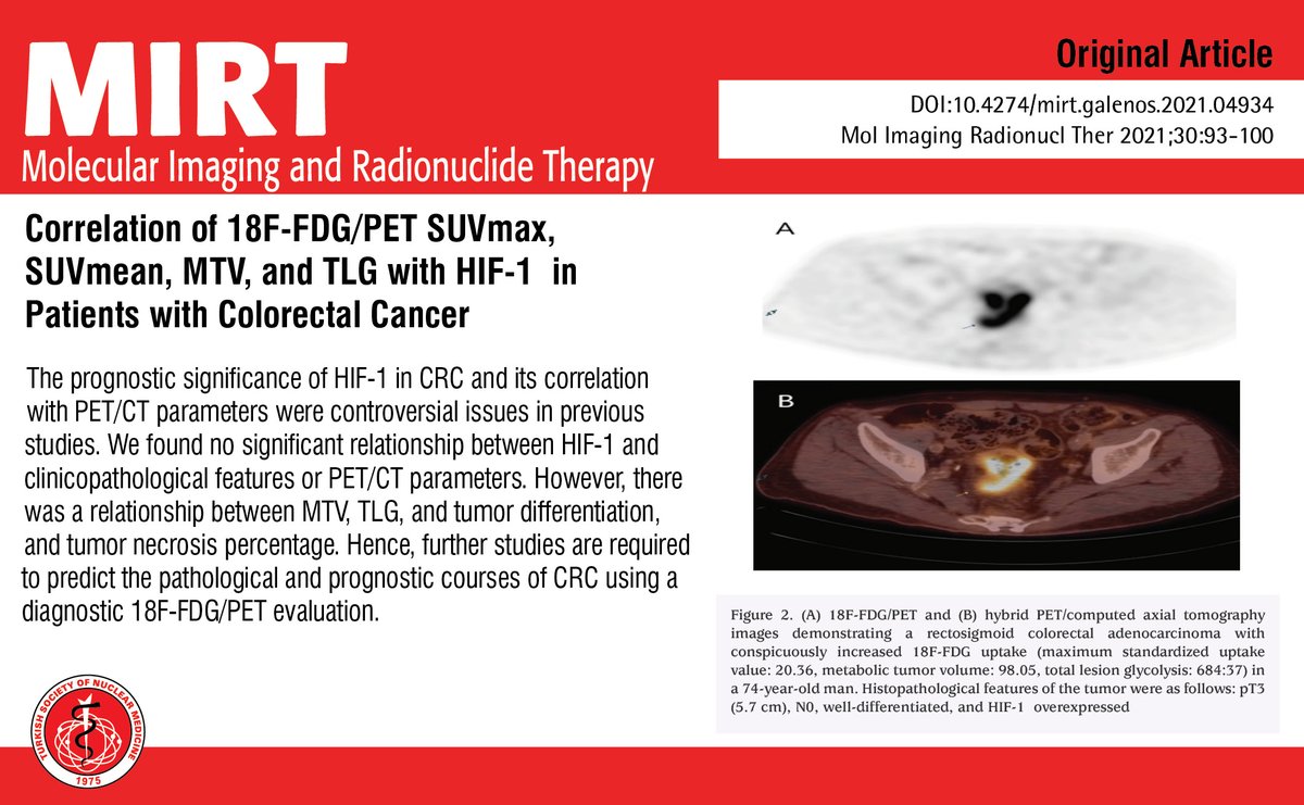 MIRTOfficial's tweet photo. Correlation of 18F-FDG/PET SUVmax, SUVmean, MTV, and TLG with HIF-1α in Patients with Colorectal Cancer
You can see the free full text of the research by Zümrüt Arda Kaymak et al.
Link : https://t.co/2zoXrCttuh
#Hypoxia #inducible #factor1 #colorectal #cancer https://t.co/tn6697lfDw