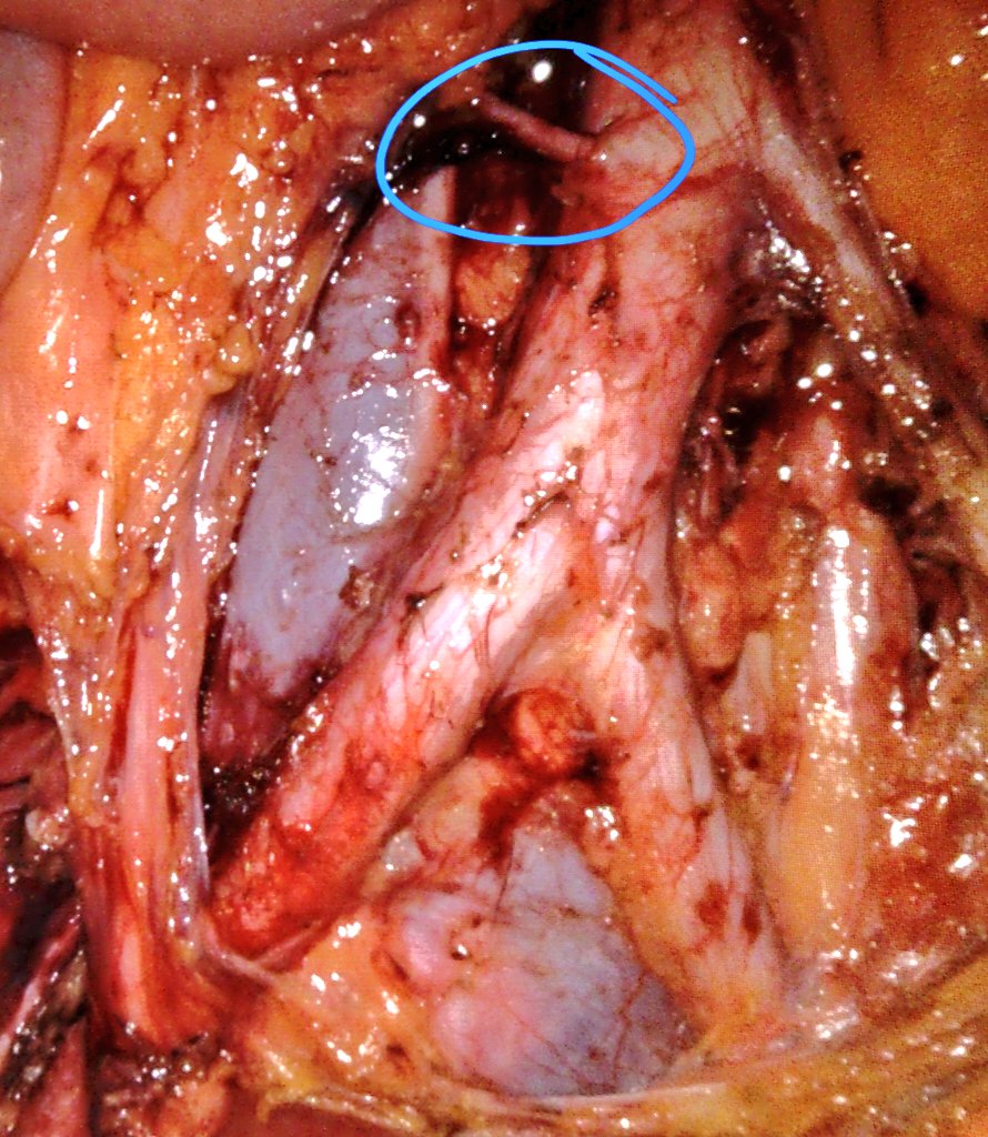 Dr Kanika Batra Modi (@kanicabatra9) on Twitter photo Robotic retroperitoneal dissection in a case of high grade Cancer endometrium, bumped into this !..aberrant precaval renal artery ?
<a href="/ENYGO_official/">European Network of Young Gynae Oncologists</a> <a href="/IJGCfellows/">IJGC Fellows</a> <a href="/IJGConline/">IJGC</a> <a href="/ESGO_society/">ESGO</a> <a href="/MaxInstCancCare/">Max Institute of Cancer Care</a> Robotic retroperitoneal dissection in a case of high grade Cancer endometrium, bumped into this !..aberrant precaval renal artery ?
<a href="/ENYGO_official/">European Network of Young Gynae Oncologists</a> <a href="/IJGCfellows/">IJGC Fellows</a> <a href="/IJGConline/">IJGC</a> <a href="/ESGO_society/">ESGO</a> <a href="/MaxInstCancCare/">Max Institute of Cancer Care</a>