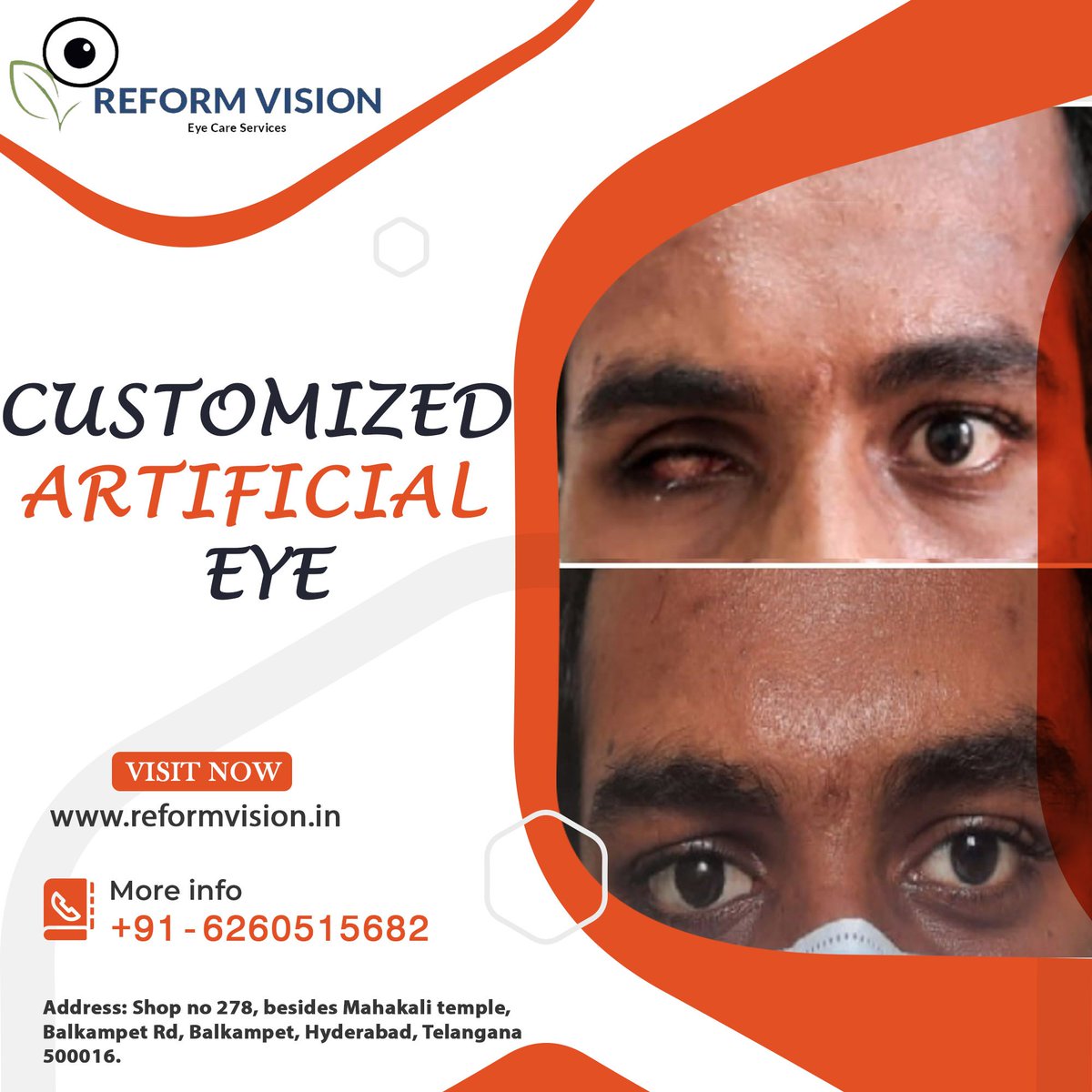 Customized artificial eye is made up of a medical grade material. It is useful for those who had to get their eye removed surgically due to trauma etc or to those who are born without eyes. #artificialeye #artificialeyes #eye #protesisoculares #prostheticeye 
#ocularprosthesis