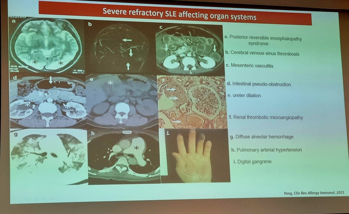 drALINAdima's tweet photo. Day 4 #Autoimmunity2022
Refractory #Lupus #Nephritis (by D Roccatello)
#TogetherInAthens https://t.co/m9Ooa1iidk