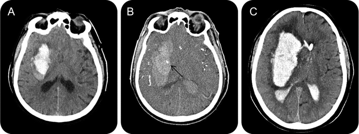 piper_tazo's tweet photo. ICH signs
increases the likelihood of hematoma growth in the first hours

CT 
(1) Black hole sign
(2) Island sign
(3) Blend sign

CTA
(4) Spot sign

Source: @StrokeAHA_ASA @GreenJournal @Radiopaedia https://t.co/cZwHXkVftK