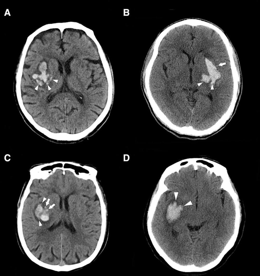 piper_tazo's tweet photo. ICH signs
increases the likelihood of hematoma growth in the first hours

CT 
(1) Black hole sign
(2) Island sign
(3) Blend sign

CTA
(4) Spot sign

Source: @StrokeAHA_ASA @GreenJournal @Radiopaedia https://t.co/cZwHXkVftK