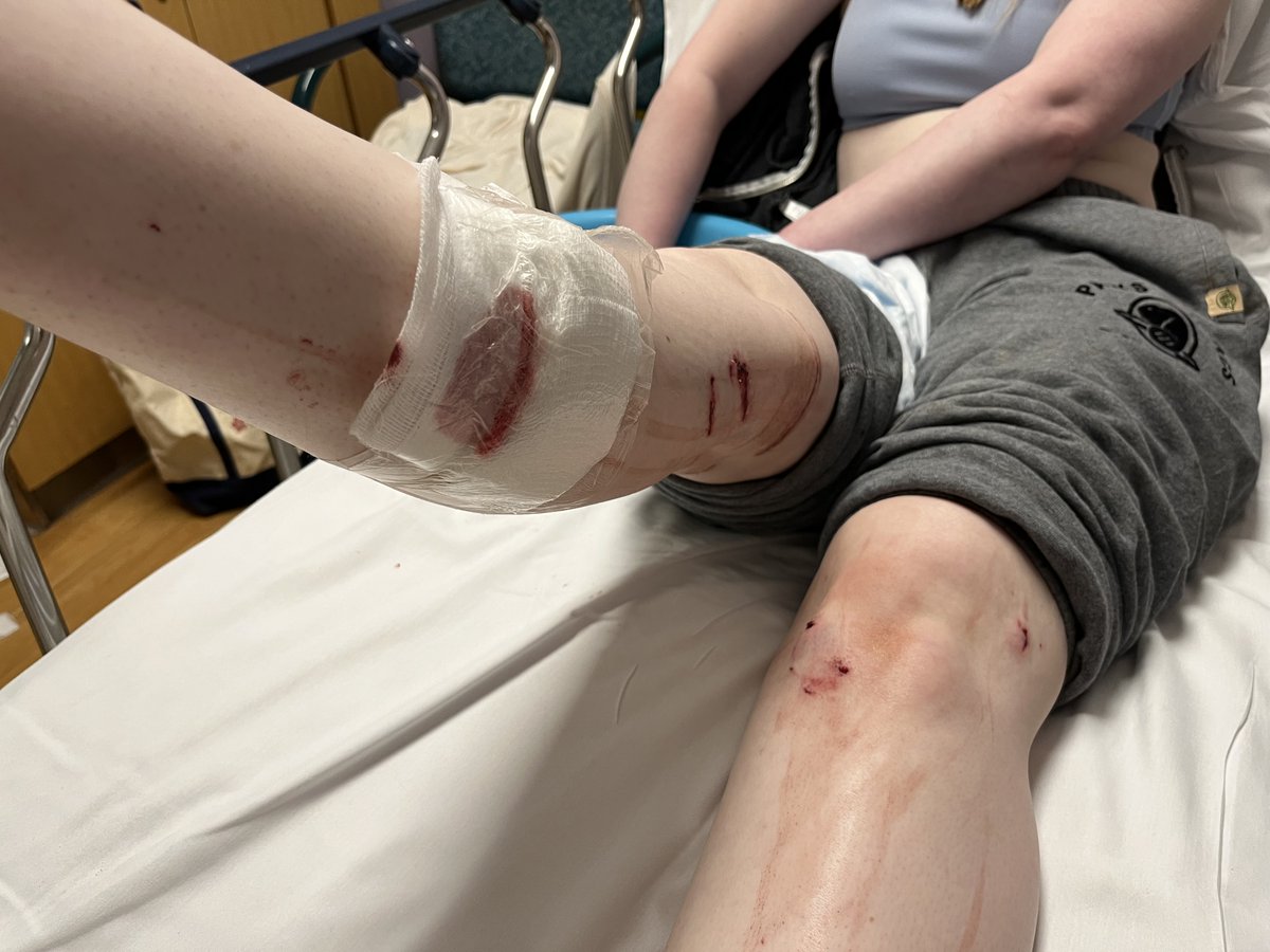 Grace Murphy who lives in the South End of Halifax was attacked by a raccoon over the weekend. She has about 8 bites and multiple scratches. Here's a pic that was taken when she was at the ER.