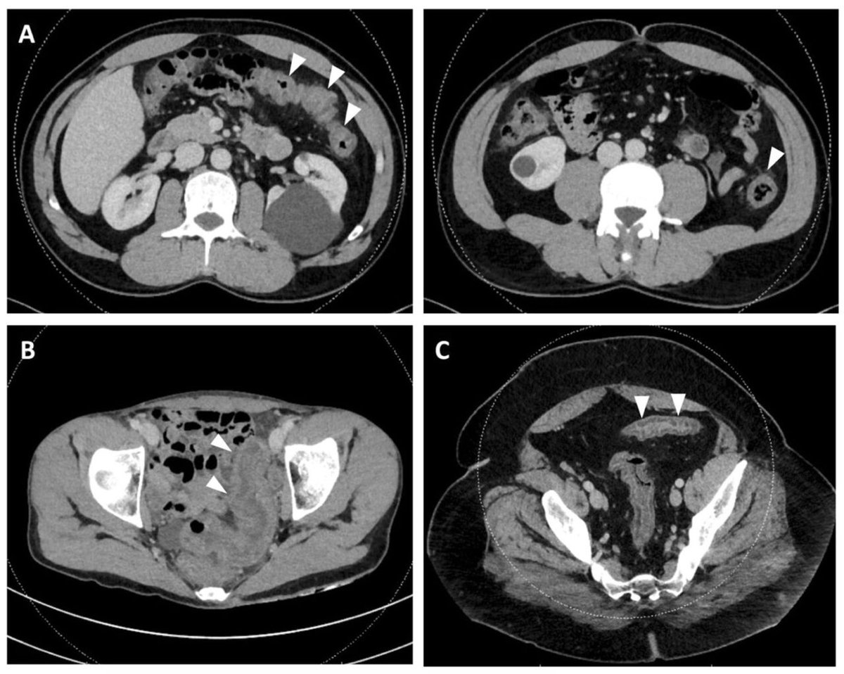 Acute #colitis is encountered on a daily basis by medical teams.

What are its aetiologies?

▶️Please find the answer here: trebuchet.public.springernature.app/get_content/a2…

#surgery, #gastroenterology, #infectiousdiseases #pathology