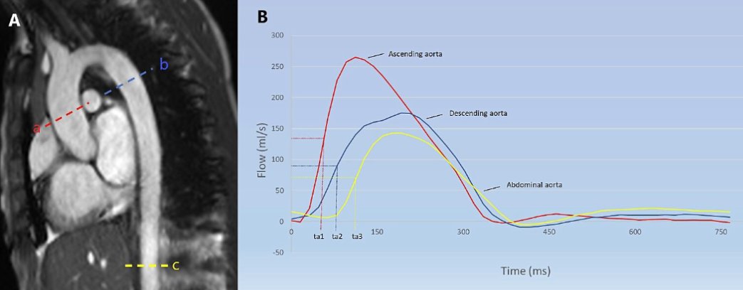 Aortic distensibility is equal in prepubertal girls and boys and increases with puberty in girls (<a href="/IkramMizrak/">Ikram Mizrak</a> et al.) - new in <a href="/ajpheartcirc/">AJP-Heart and Circ</a> 

ow.ly/paNk50Jw1cv

#childhealth #childgrowth #puberty