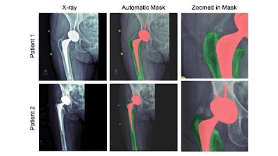 Radiology: Artificial Intelligence (@radiology_ai) on Twitter photo #DeepLearning quantifies femoral component subsidence on hip radiographs doi.org/10.1148/ryai.2… @codywylesmd @drshyamkurian <a href="/MayoRadiology/">Mayo Clinic Radiology</a> #arthroplasty #AI #MachineLearning #DeepLearning quantifies femoral component subsidence on hip radiographs doi.org/10.1148/ryai.2… @codywylesmd @drshyamkurian <a href="/MayoRadiology/">Mayo Clinic Radiology</a> #arthroplasty #AI #MachineLearning