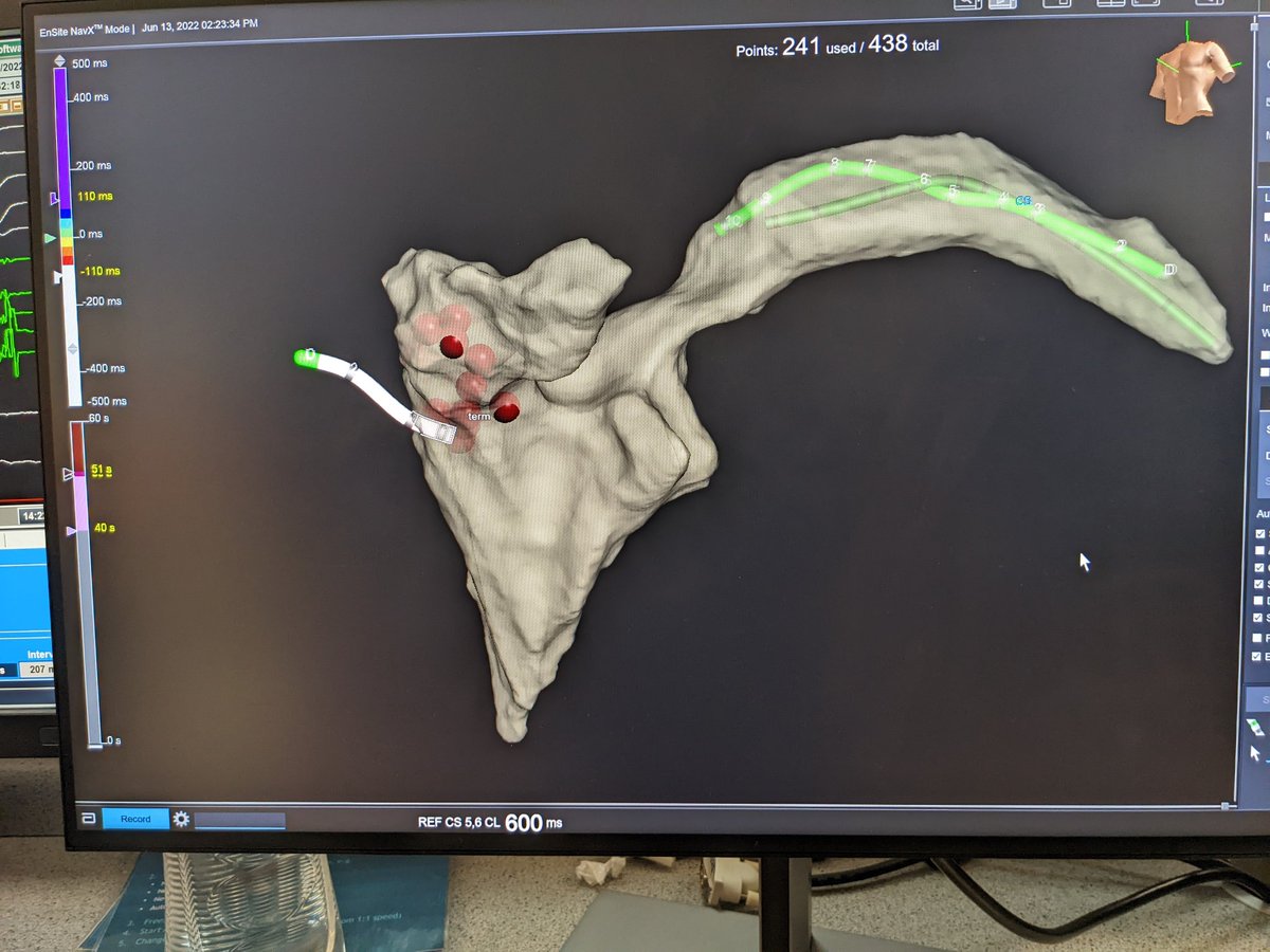 ProfDConnelly's tweet photo. I'm a bit late to the #fluorofree / #zerofluoro party - but managed a CTI-dependent atrial flutter case today, with some help from @JamesEP14 and Alex Saban @AbbottCardio https://t.co/28eHOGOTSt