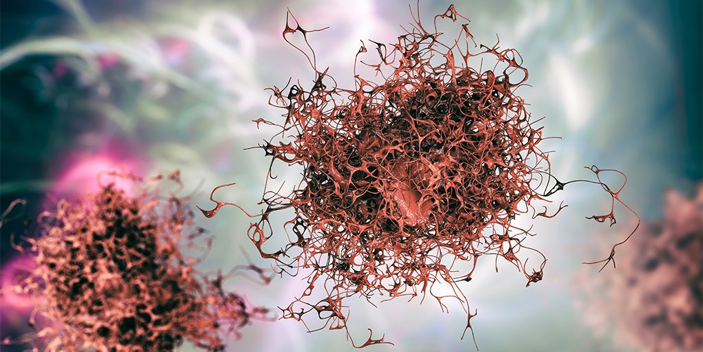 Cancer Discovery's #ResearchWatch: Aged Lungs Enable Metastatic Outgrowth of Dormant #Melanoma Cells, a summary of the paper by @FaneMitchell, @Yash_Chhabra, @AshaniTW et al. bit.ly/3Hi6MeN @JHSPHBMB