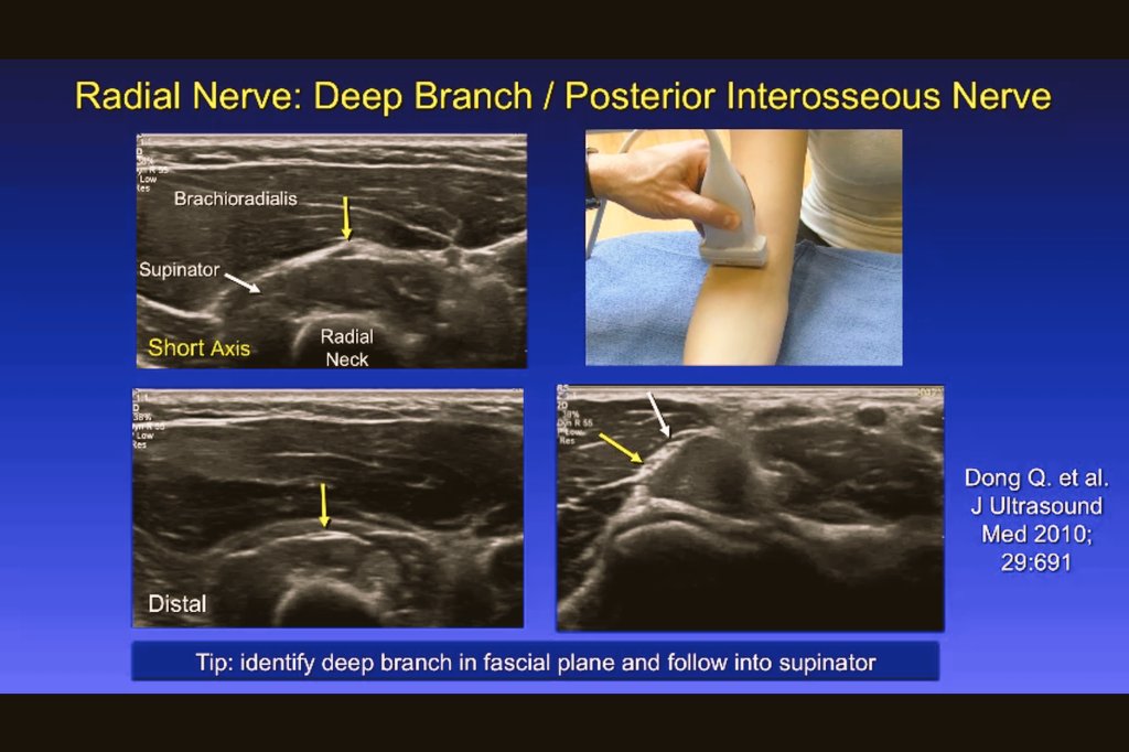 Ultrasound of the Elbow
Great Instructional 
FREE VIDEOS

ajronline.org/doi/suppl/10.2…

ajronline.org/doi/suppl/10.2…